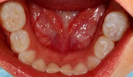 Llegeix aquest article per a aclarir què són i per a què serveixen els segelladors dentals, entre altres dubtes