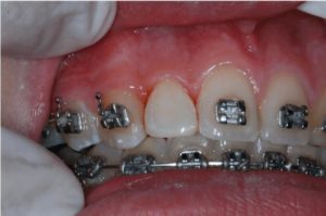 Restauración estética dental