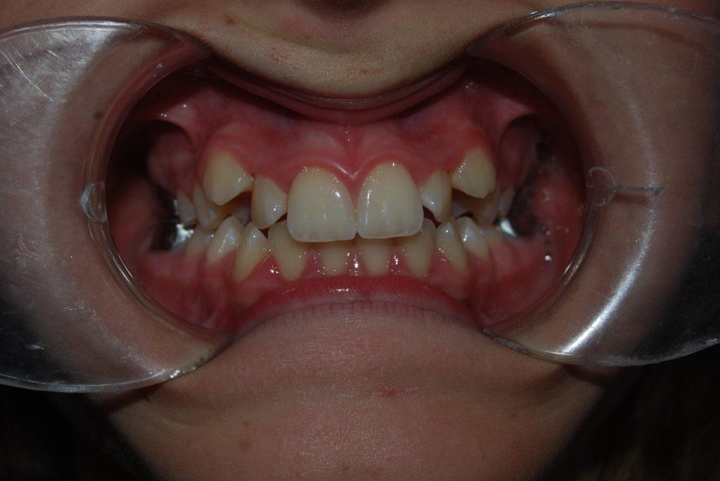 Maloclusión dental