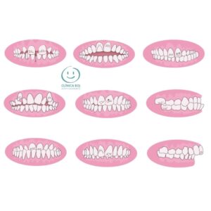 Malocclusion