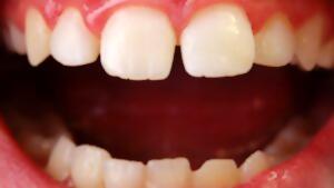 Clinical cases dental esthetics