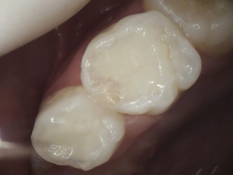 Reconstrucció dental