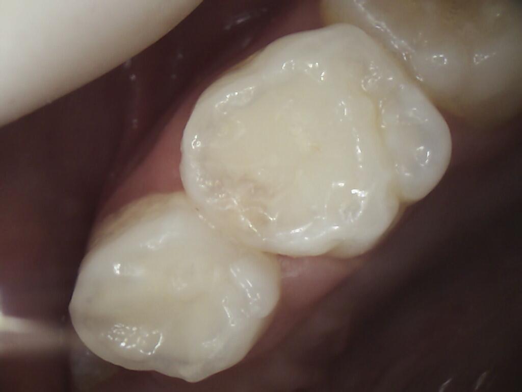 Dental reconstruction