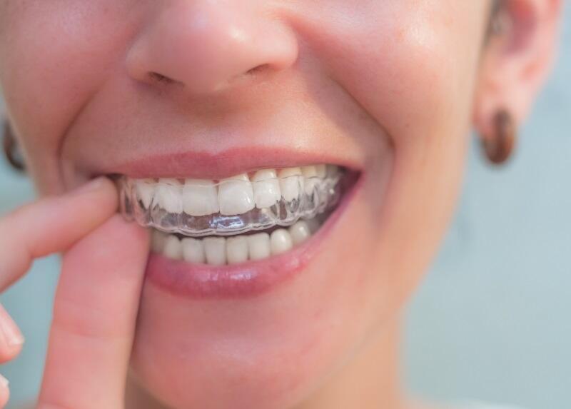 best clear aligner Technic Platform