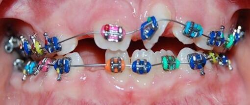 Brackets for children and young people