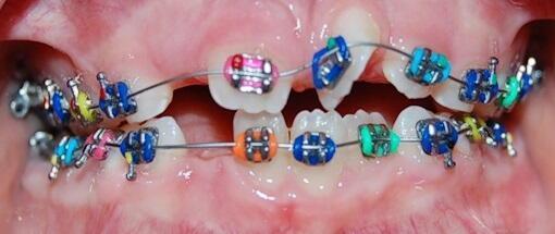 Brackets per a nens i adolescents