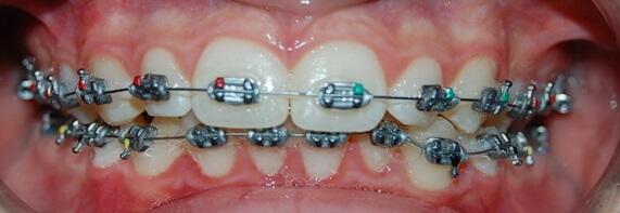 Brackets for children and young people