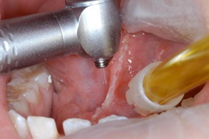 Laser oral surgery