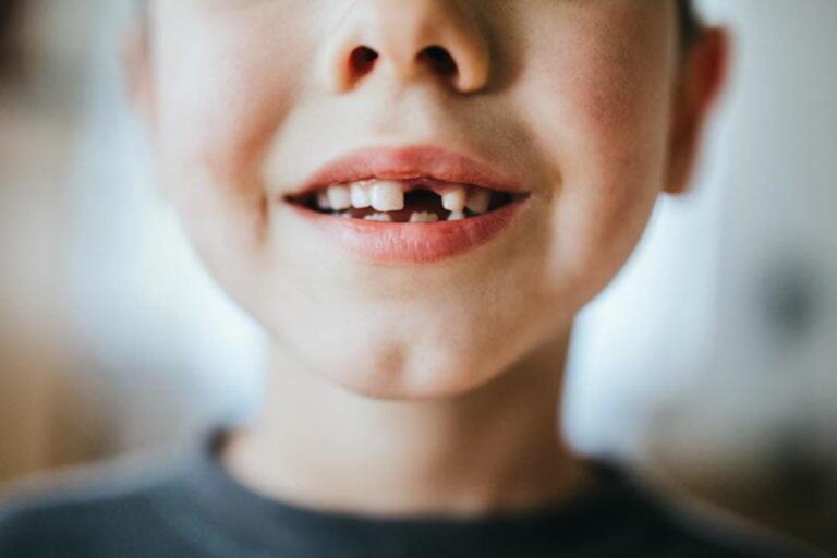 Avulsió dental en nens, adolescents i joves