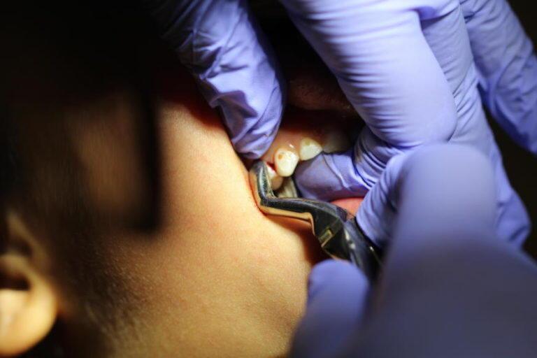 Tooth extraction in children and teenagers