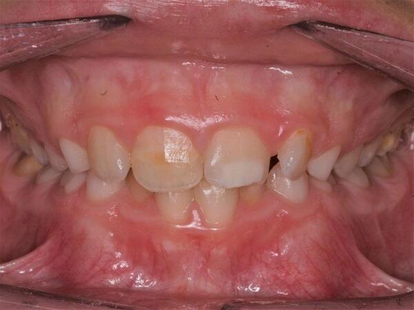 Hipoplàsia dental en nens i joves