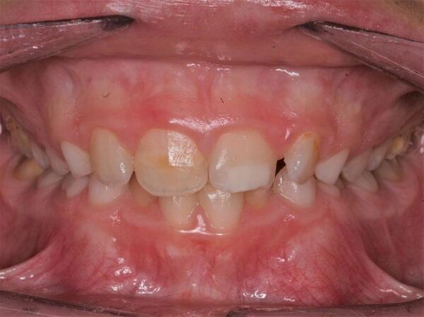 Paediatric & Juvenile Dental Hypoplasia