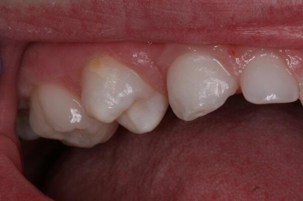 Hipomineralizació dental en nens i joves