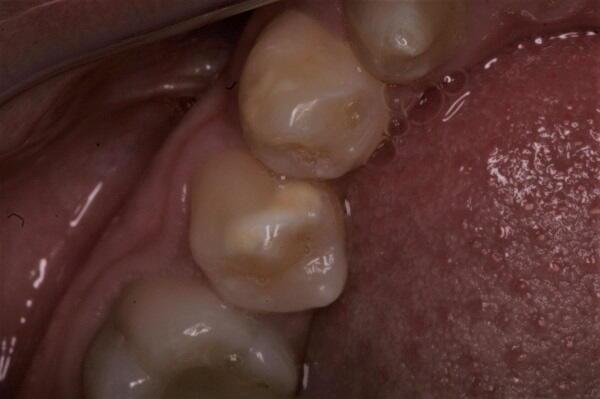 Hipoplàsia dental en nens i joves