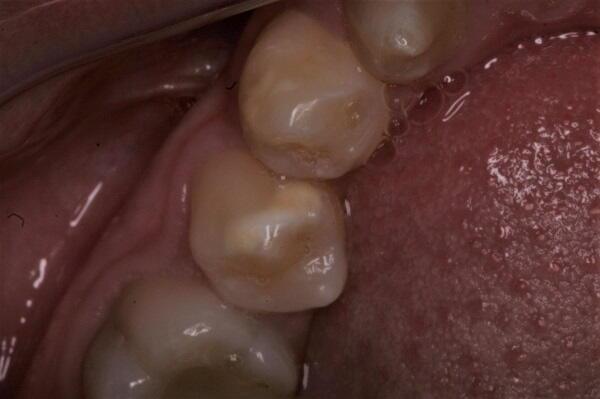 Paediatric & Juvenile Dental Hypoplasia