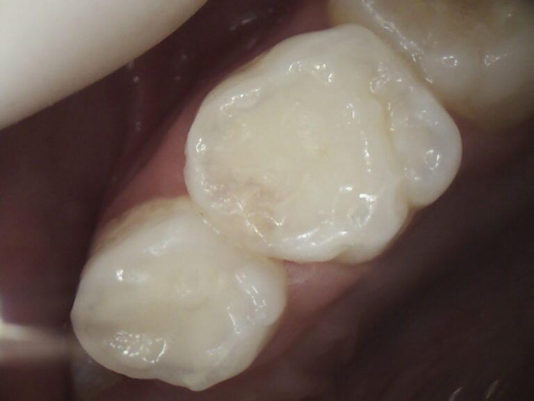 Hipoplàsia dental en nens i joves