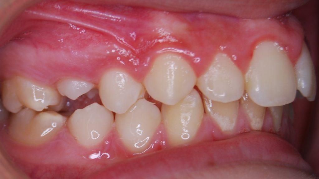 ortodoncia estética antes lado derecho