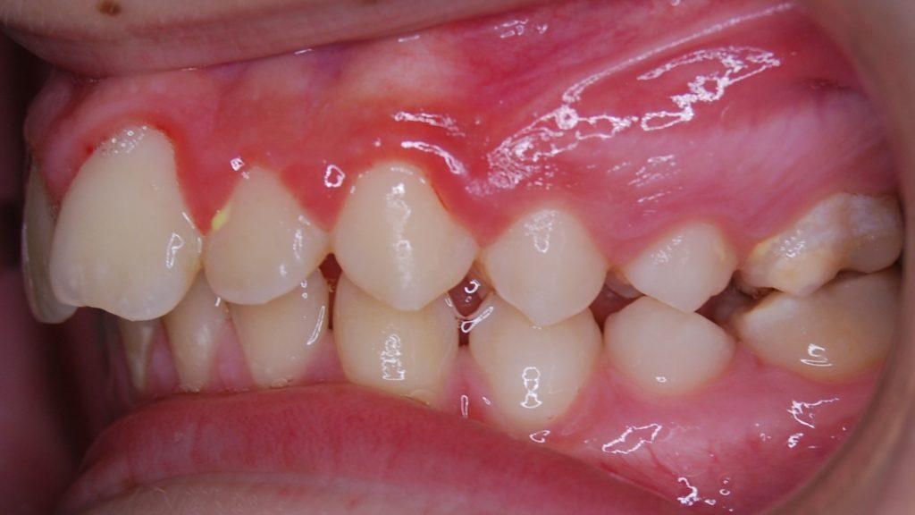 ortodoncia estética antes lado izquierdo
