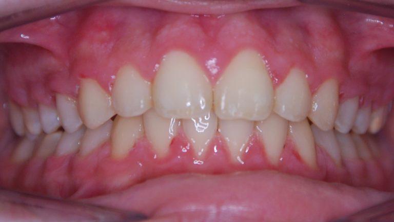 Presentación de un caso de ortodoncia