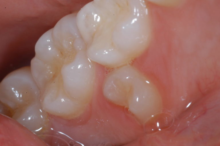 Premolares