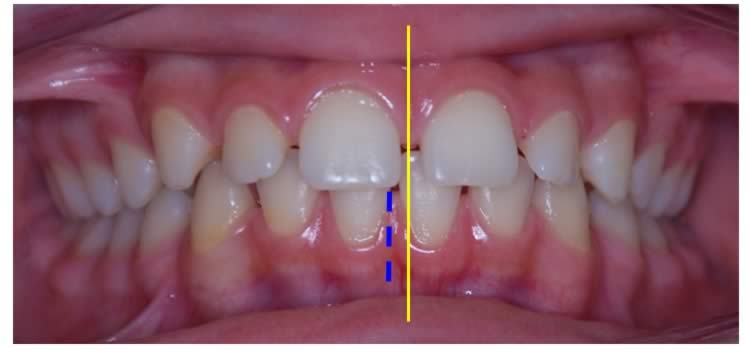 diastema dental