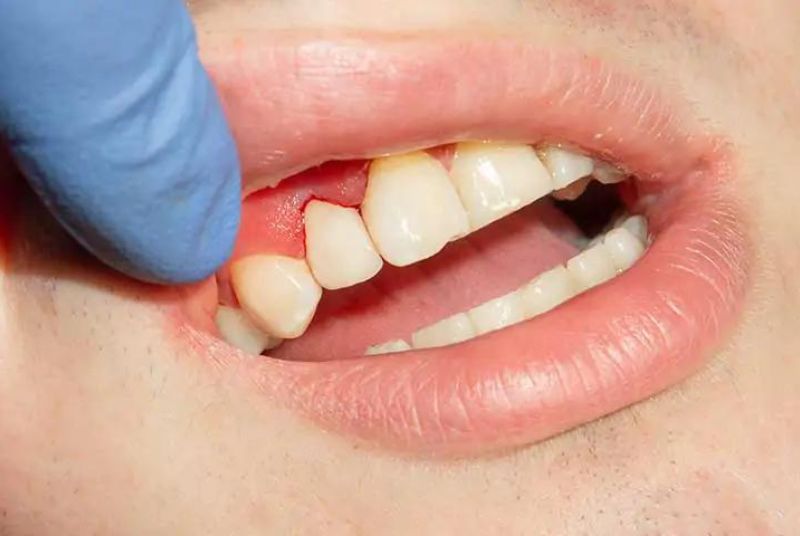 severe chronic periodontitis