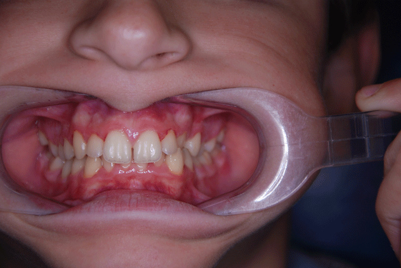 Deep bite when does it exist & treatment BOJ pediatric dentistry