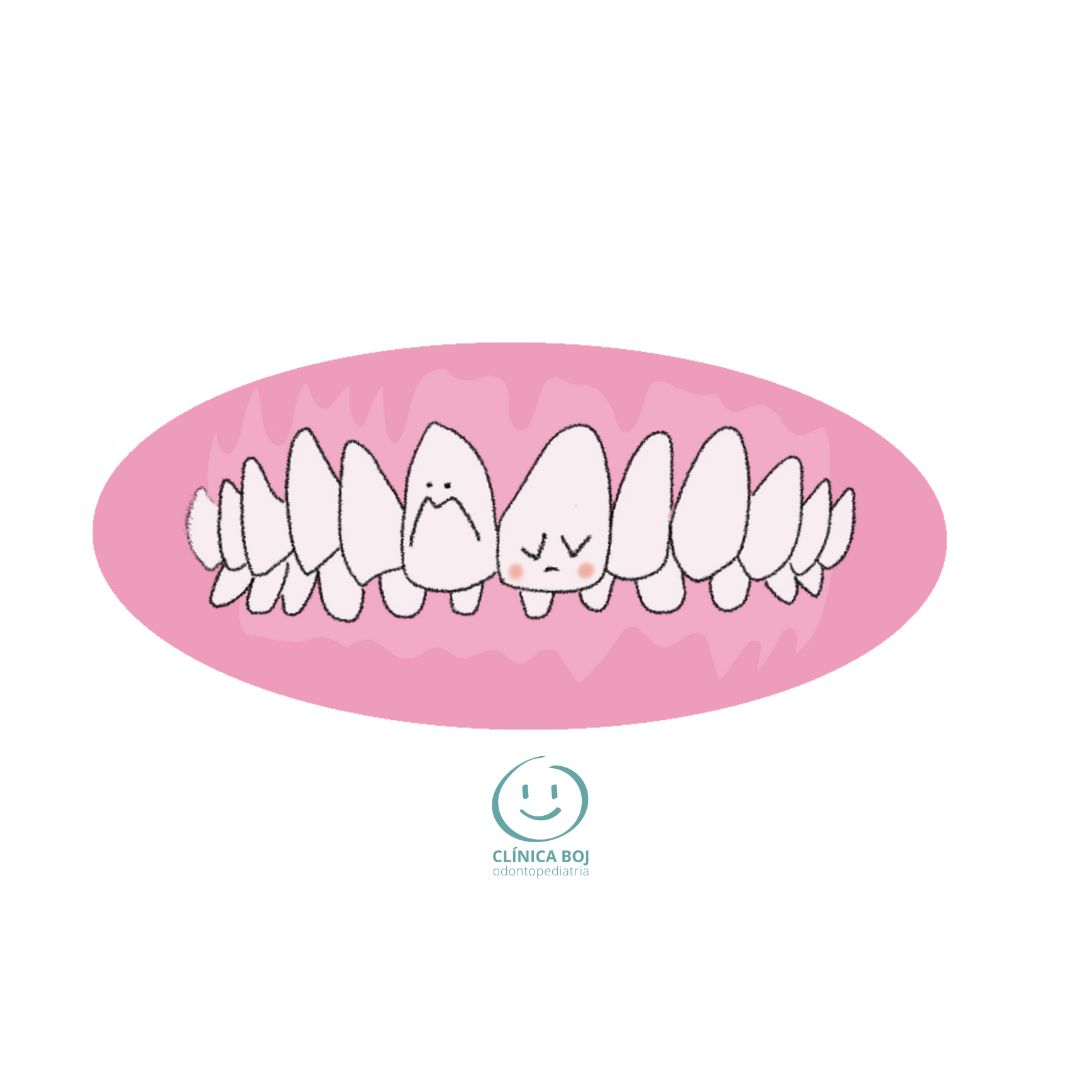 Deep bite when does it exist & treatment BOJ pediatric dentistry