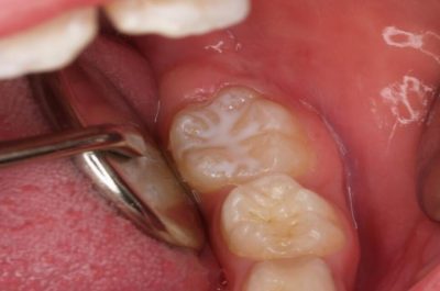 Caries en niños, adolescentes o jóvenes en estadios más iniciales Caries en niños, adolescentes o jóvenes en estadios más iniciales