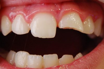 Dental dislocation or displacement