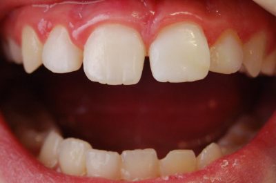 Dental avulsion