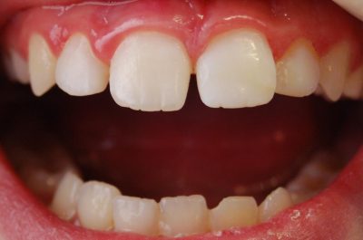 Dental avulsion Dental avulsion