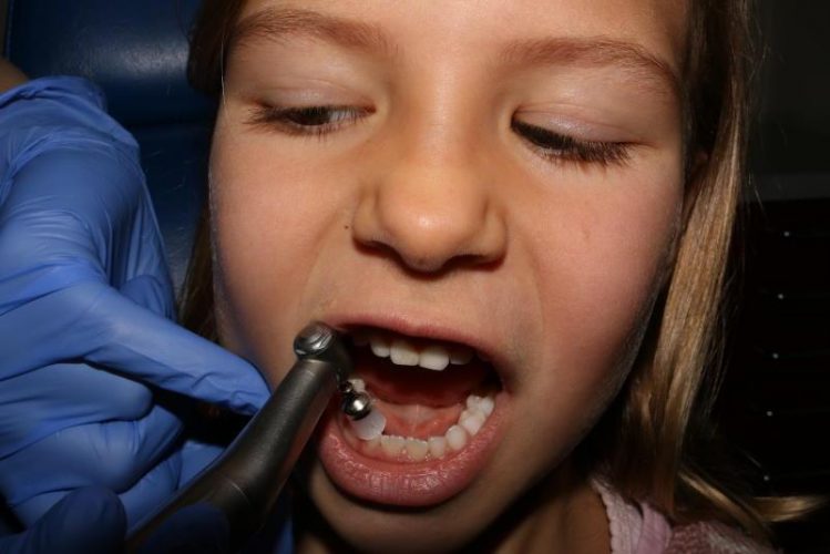 Limpieza dental niños
