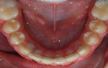 Brackets linguales Brackets linguales