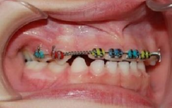 Ortodoncia con brackets Ortodoncia con brackets